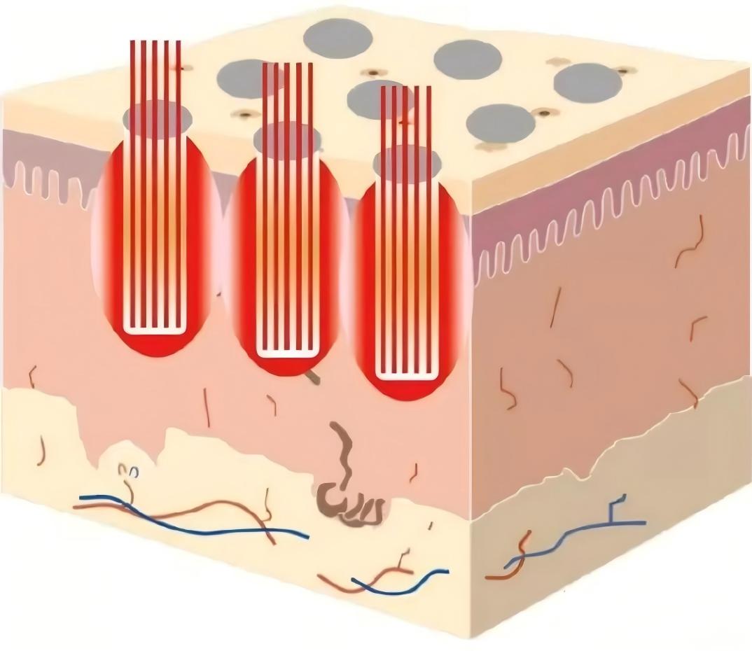 laser dot medical cure DOE - micro optics,optical filter,infrared components